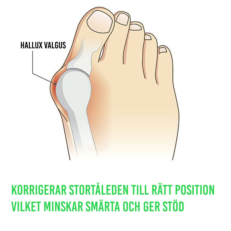 "Silikonskydd för Hallux Valgus i beige silikon, ger stöd och komfort för fötterna, perfekt för daglig användning i skor."